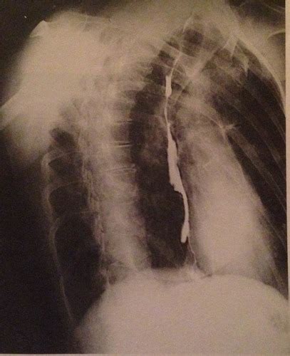 Image result for Modified Barium Swallow Video Example