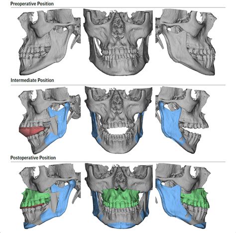 Jaw Expander for Adults - Modern Orthodontic Clinic in Sammamish & Bellevue