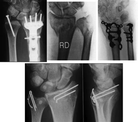 Image result for Open Reduction Distal Radius Fracture