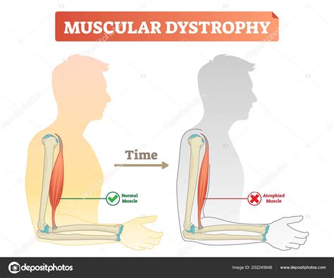 Vector illustration about muscular dystrophy. Compared normal muscle and atrophied muscle ...