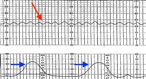Reactive Fetal Heart Rate Tracing