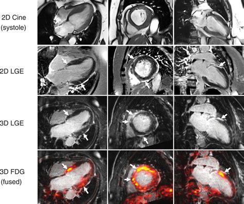 Active Cardiac Sarcoidosis | Circulation