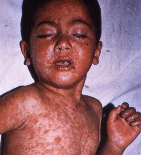 India jeopardising global measles death target | TopNews