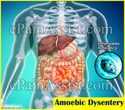 Amoebic Dysentery|Causes|Spread|Symptoms|Treatment|Prevention - symptoms of dysentery