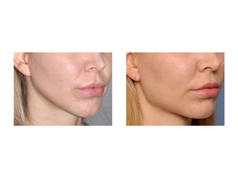 Plastic Surgery Case Study - Female Jaw Angle Implants - Explore Plastic Surgery
