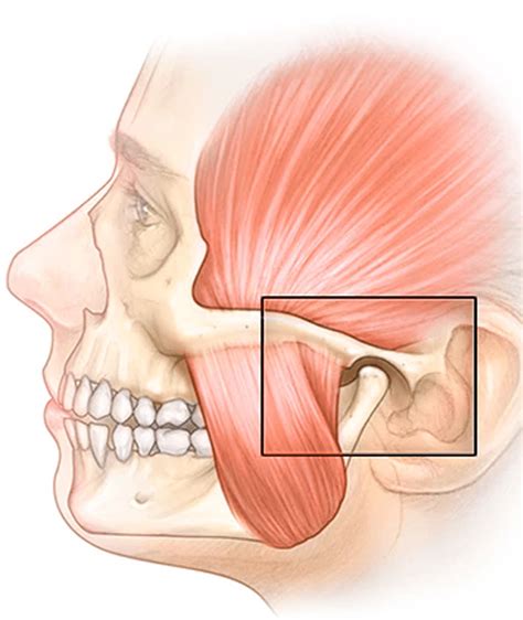 TMJ (Temporomandibular Joint Dysfunction) | Mississauga TMJ Dental Care ...