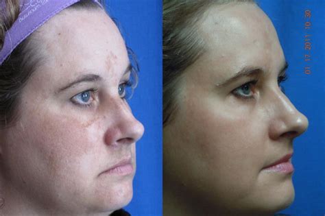 What’s the Best Laser Treatment for Hyperpigmentation? – Dr. Kevin Johnson’s Advanced Aesthetics