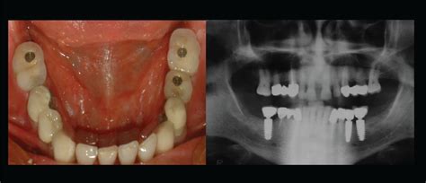 Smoking, number of Implants Placed and implant location linked to early ...