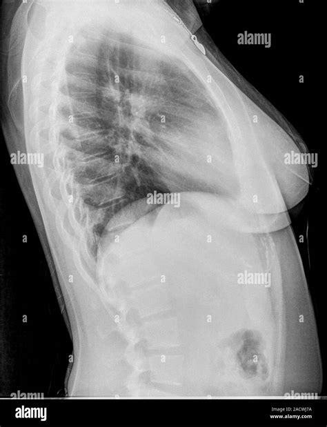 Pneumonia X Ray Side View