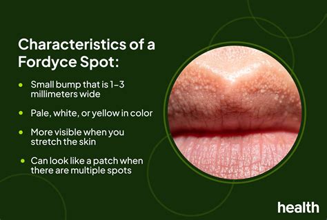 White Spots On Lips Hpv Spotting Mouth Ulcers Vs. Oral Cancer Early