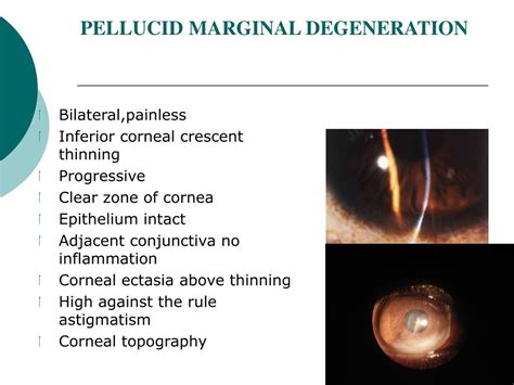 PPT - Clinical Approach to Non-Infectious Peripheral Ulcerative Keratitis (PUK) PowerPoint ...