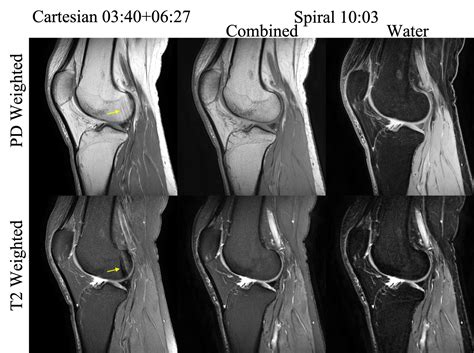 T2 Mri Of The Knee