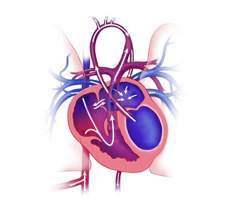Hypoplastic Left Heart Syndrome (HLHS) | Texas Children's