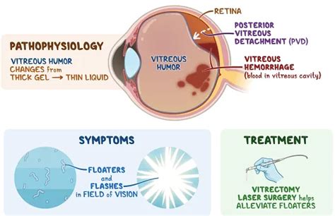 Retina Surgery – Bharti Eye Foundation