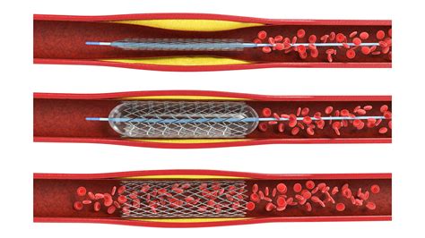 Stents | Victor Chang Cardiac Research Institute