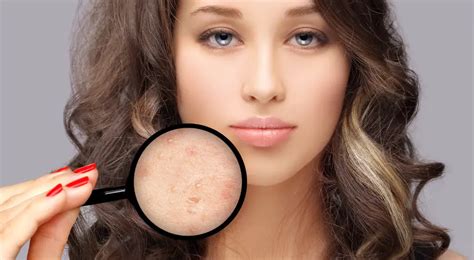Understanding Acne Scars: Types, Causes, and Effective Treatments