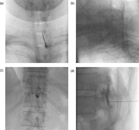 EP151 Double simultaneous targeted epidural blood patch in refractory ...