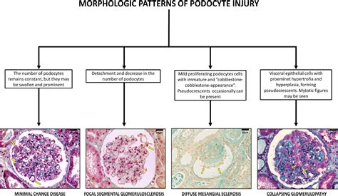 Focal Segmental Glomerulosclerosis
