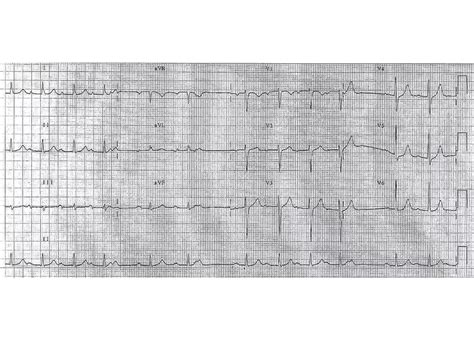 ECG Lecture: Sinus arrest, sinoatrial exit block, AV block and escape ...