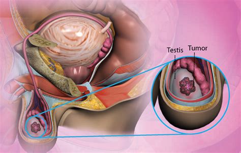 Testicular cancer - Care at Mayo Clinic - Mayo Clinic