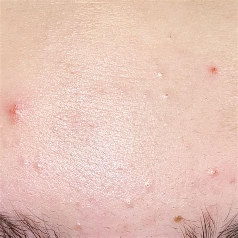 please help !!! i get these closed comedones on my forehead and my chin. i have combination skin ...