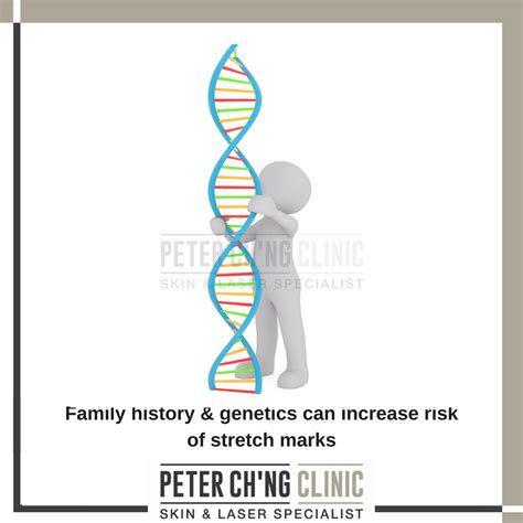 Are Stretch Marks Genetic