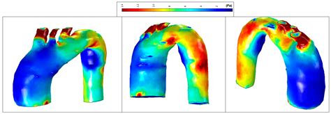 Aorta Ascending Aneurysm Analysis Using CFD Models towards Possible ...