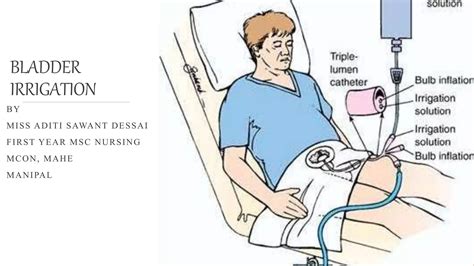 Bladder irrigation | PPTX