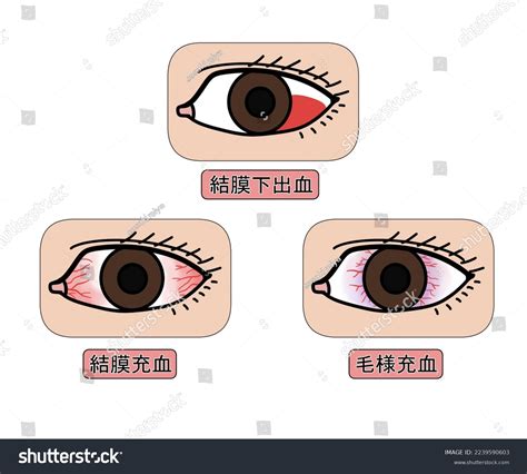 Subconjunctival Hemorrhage Conjunctival Hyperemia Ciliary Hyperemiamedical Stock Illustration ...
