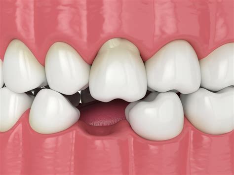 What are dry sockets? | Perry Dental & Perry Dental Kids