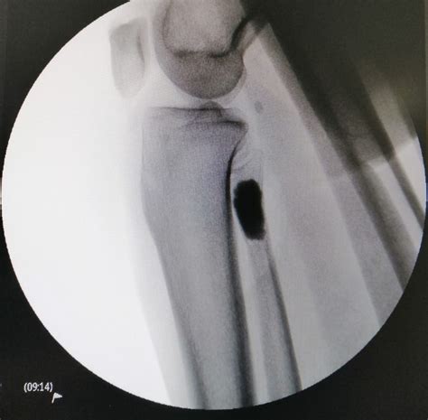 Image result for Exploding Massive Knee Abscess