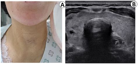 A Case of Diffuse Thyroid Hematoma after Ultrasound-Guided Fine Needle ...