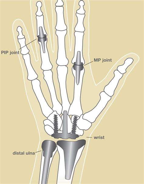 Joints Of Hand Wrist Pain: Causes, Symptoms, Treatments, And Diagnosis