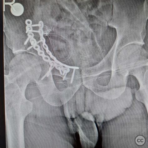 acetabulum fracture