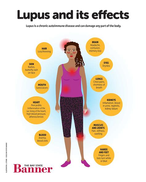 Lupus: The great imitator – The Bay State Banner