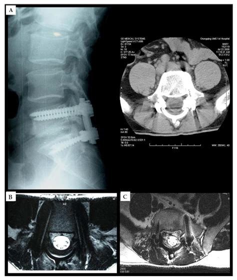 Polymeric Dural Biomaterials in Spinal Surgery: A Review