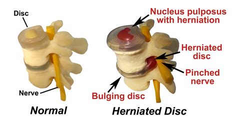 Bulging Disc Vs Herniated Disc Whats The Difference