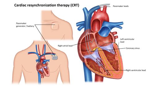 Image result for Installing Pacemaker
