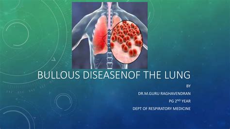Bullous Lung Disease