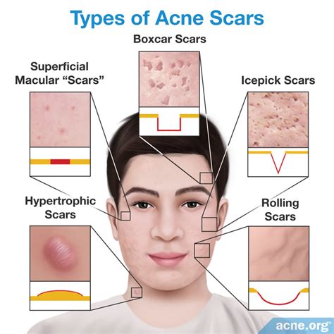 What Type Of Acne Causes Scars at Caitlin Shaeffer blog