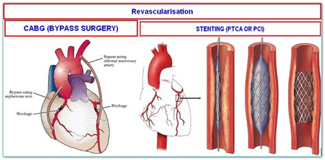 Coronary Artery Bypass Grafting (CABG) - almostadoctor