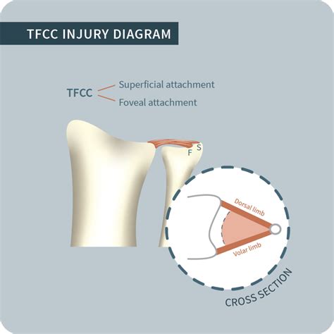 Triangular Fibrocartilage Complex Injuries Surgery & Treatment Cape Town