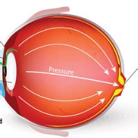 Prime Eye Hospital & LASIK Centre , Alwar - Prime Eye Hospital and ...