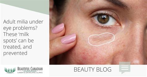 Milia Under Eye
