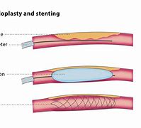 stenting 的图像结果