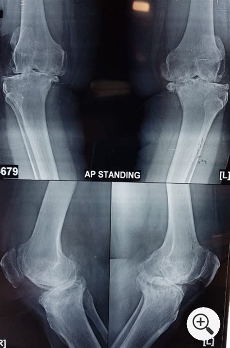 Total Knee Replacement & Exercise Guide | Spine, Hip & Knee Surgery ...