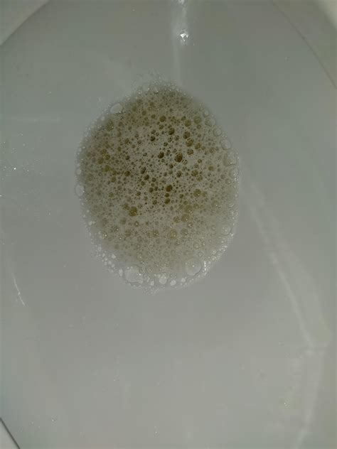 Foamy Urine Loose Stool at Sarah Kilgore blog