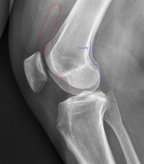 Lateral Knee Radiographs | Radiology Article | Radshare.net