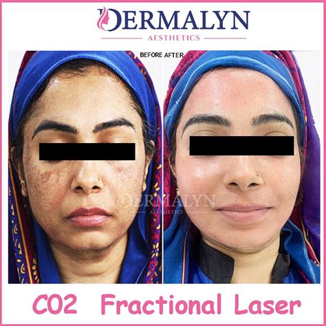 Semi Permanent Makeup Clinic at Best Price in Delhi