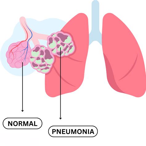 PNEUMONIA - Causes, Symptoms & Treatments with Herbal | Ayurvedic | Su ...